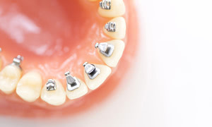 歯列矯正を行うことで、フェイスラインがすっきりする人の特徴