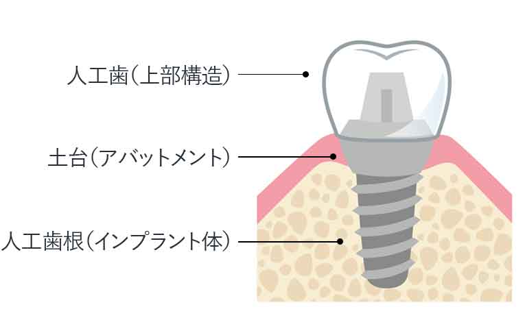 インプラントの構造