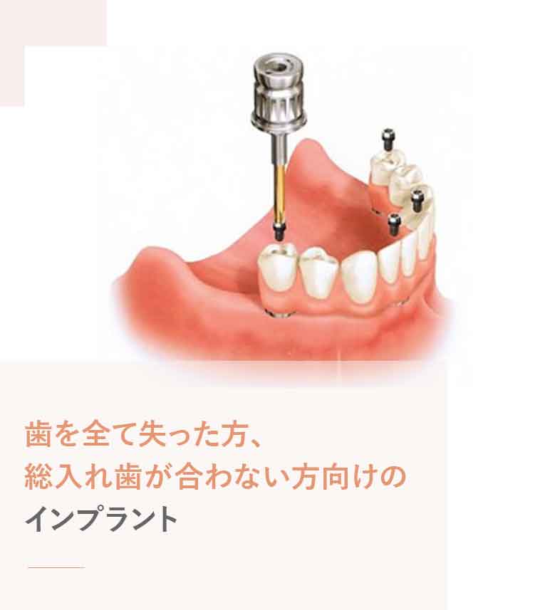 オールオン4
