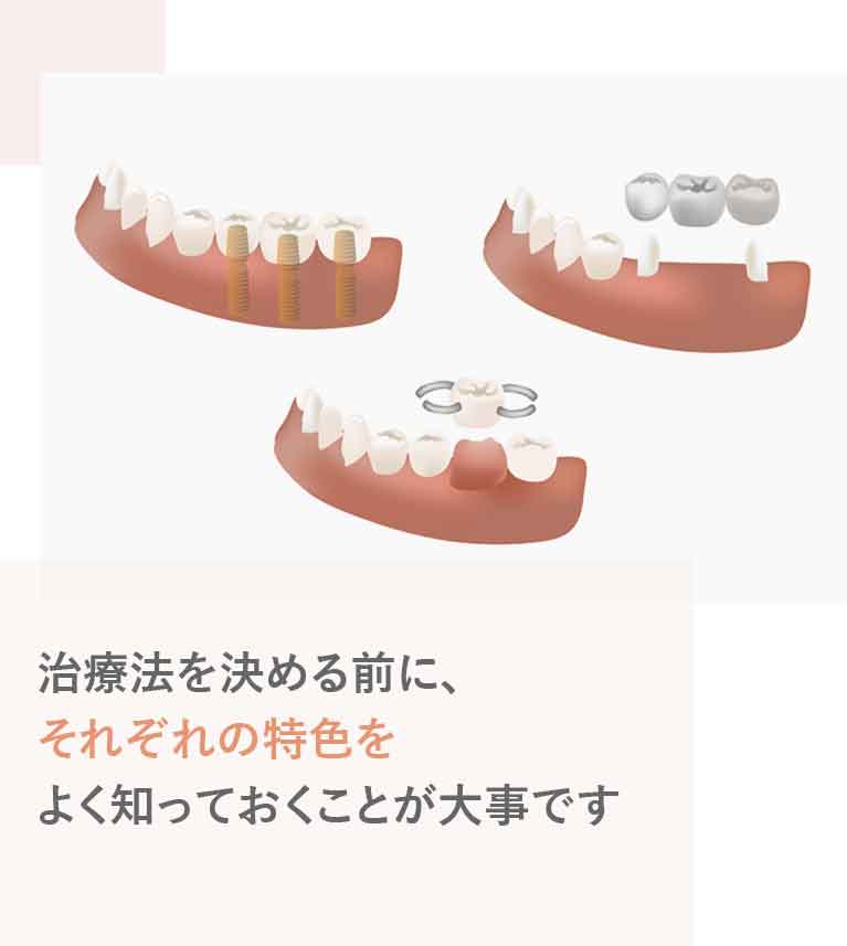 インプラントとブリッジ・入れ歯との比較