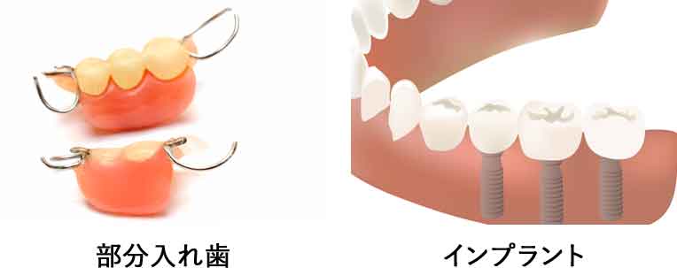 インプラントの構造
