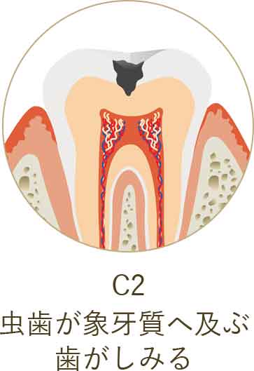 虫歯が象牙質へ及ぶ 歯がしみる