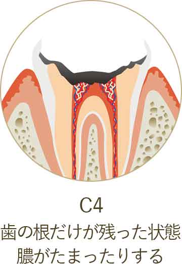 歯の根だけが残った状態 膿がたまったりする