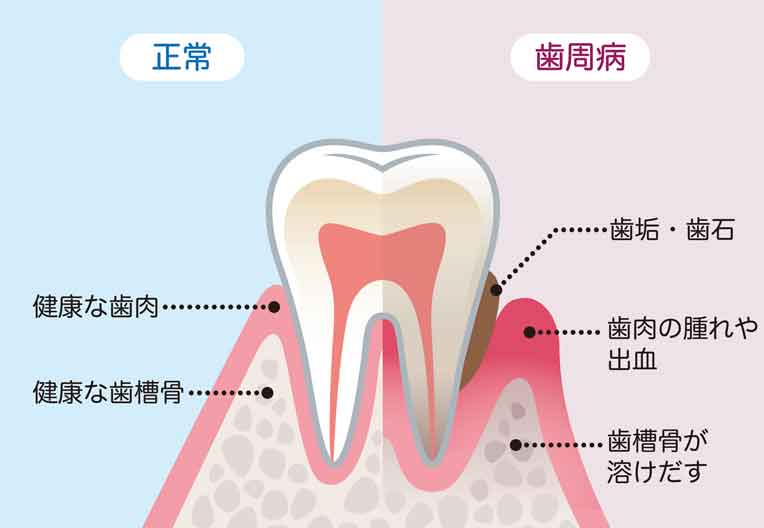 歯周病の原因・メカニズム
