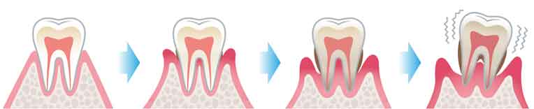 歯周病の症状と進行段階