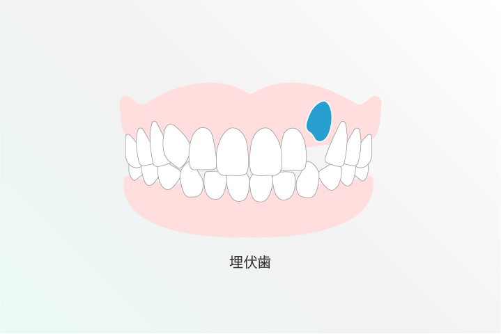 取り外しのできる装置を使用します