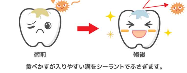 シーラント