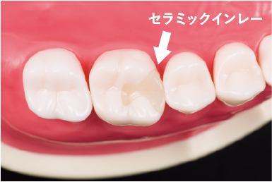 詰め物 セラミックインレー