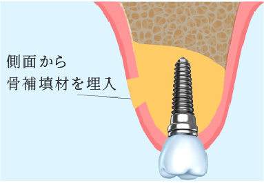 骨造成