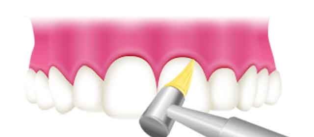 歯と歯のすき間を清掃
